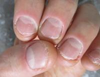 Methods to get rid of the habit of biting your fingernails