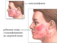 Как легко избавиться от шрамов на лице?